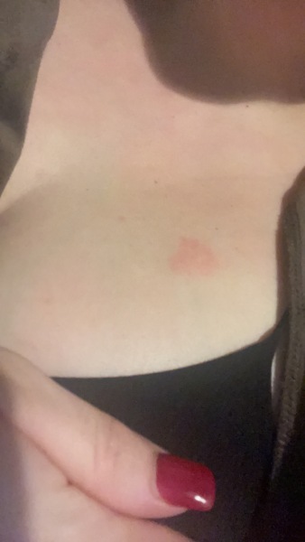 Rash or bug bites? (Pic attached)