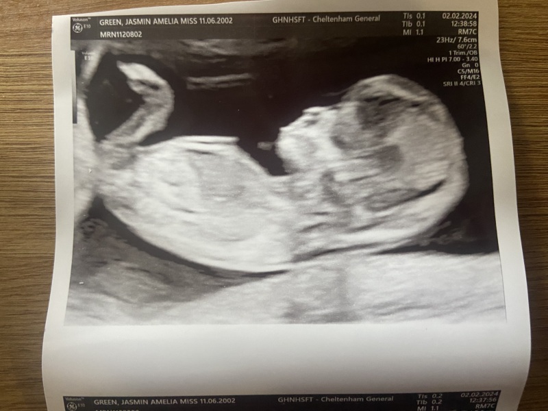 12 week nub theory/gender guesses