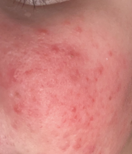To feel so so down about my skin. Rosacea? Photo included