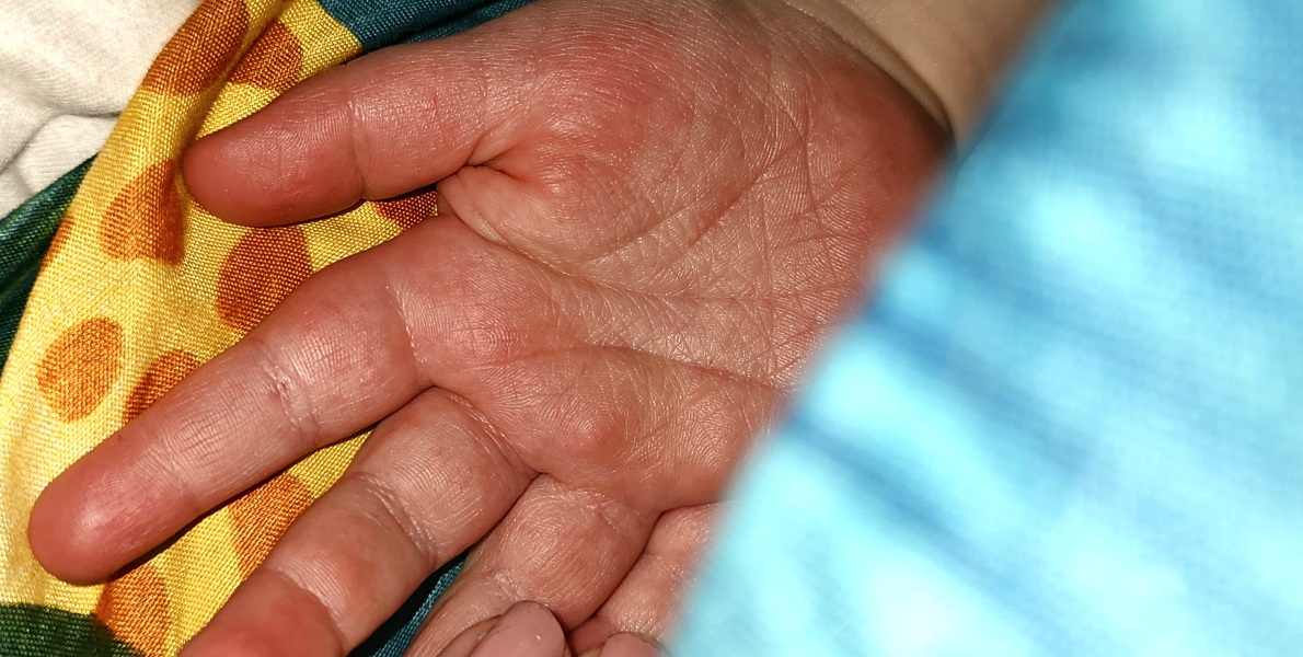 3 year old rash - any ideas please?