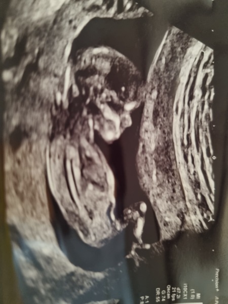 Has anyone been told the gender at 12 week scan?