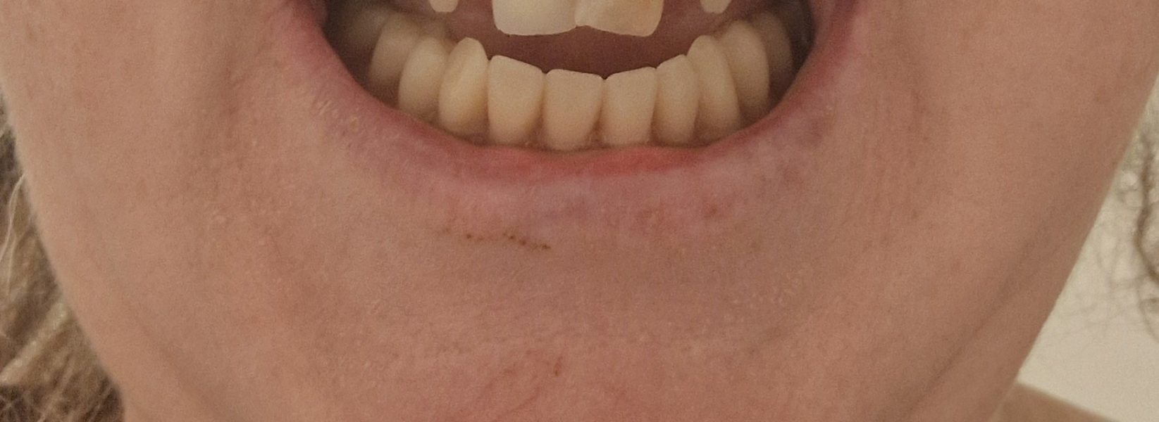 Can you tell theses are dentures