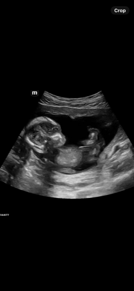 Gender guess anyone 💙🩷