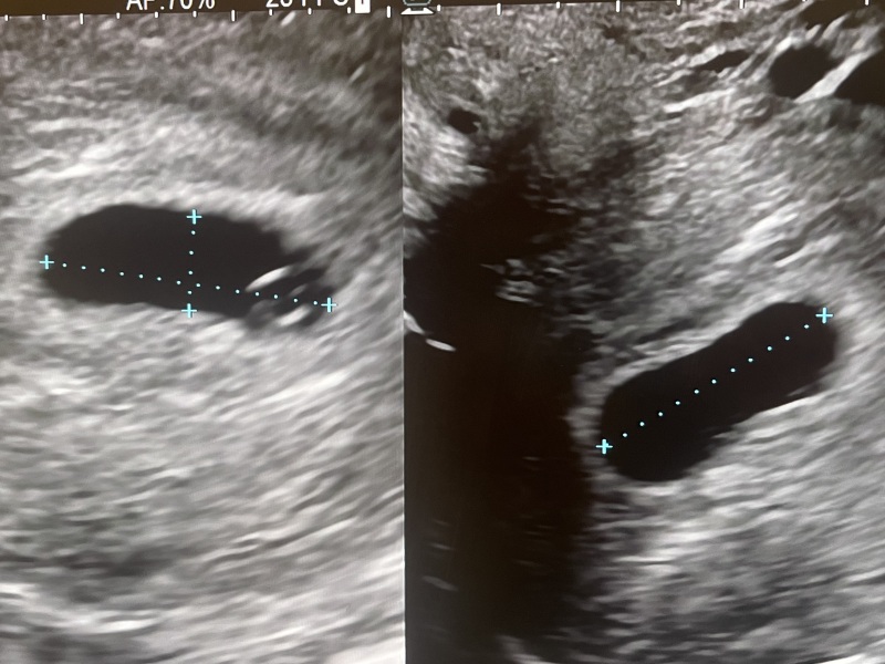 Scan today at 6weeks no yolk