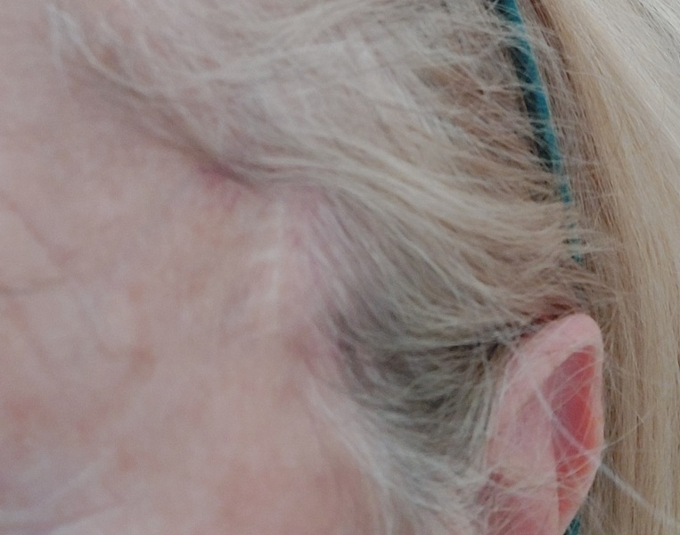 Seborrheic keratosis removal