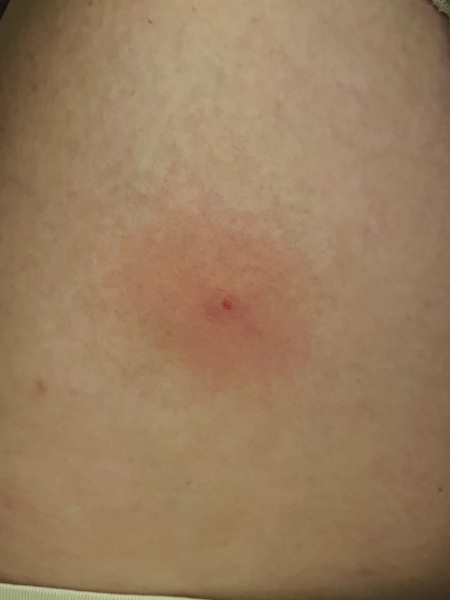Bug Bite