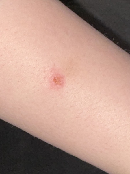 Odd circular wounds on limbs - bites??
