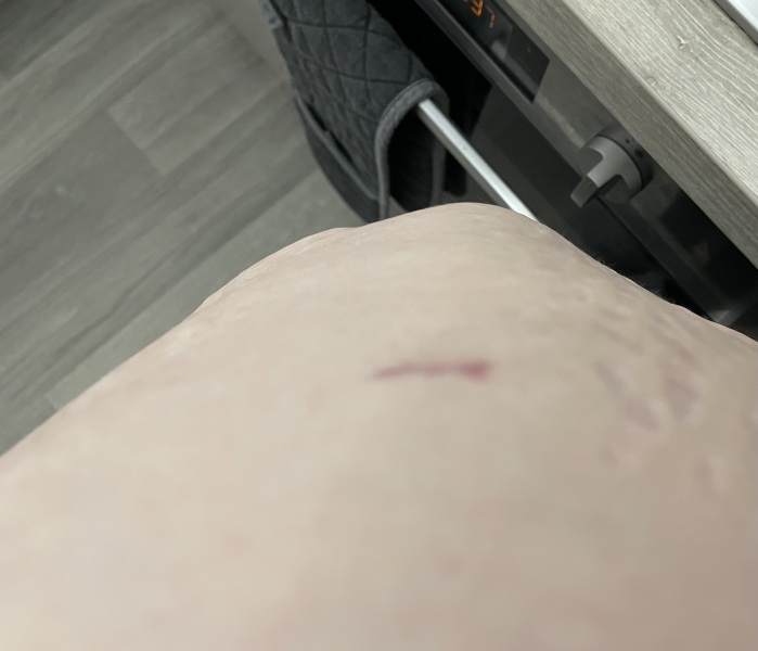 Hernia after gallbladder removal?!