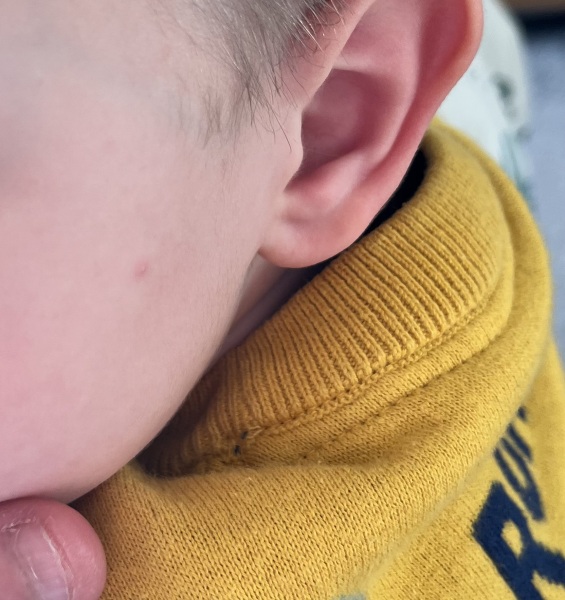 What is the best age to get chicken pox?