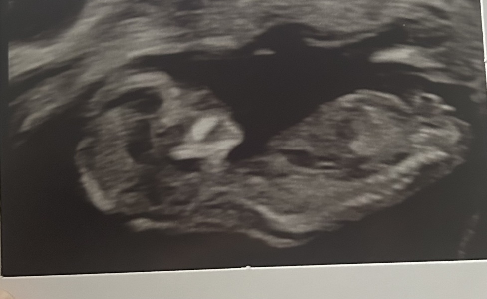 12 week scan gender guess