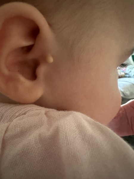 Baby skin tag ear