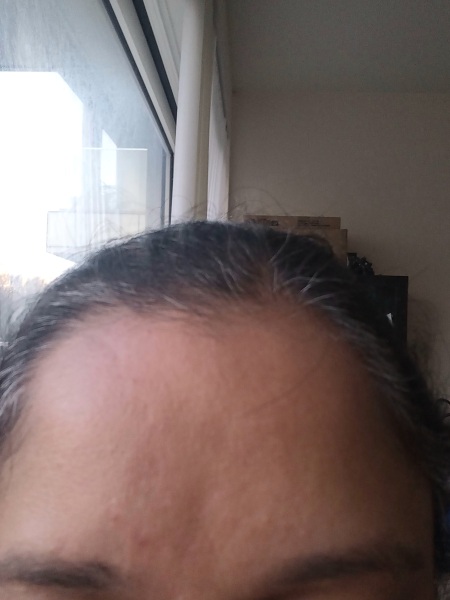 Botox is it worth it?