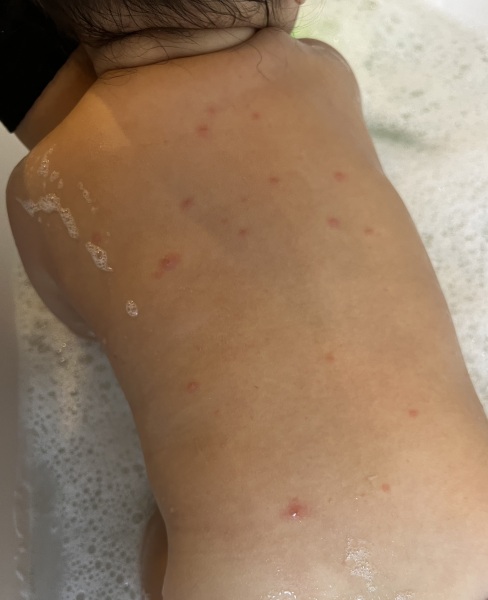 Is this chicken pox??? (With pic)