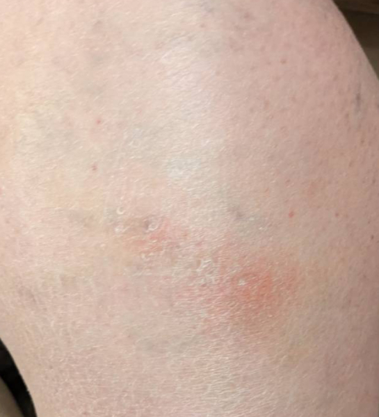 Anyone else had a pulmonary embolism? Hand hold needed.