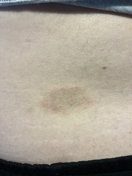 Eczema, psoriasis or something to worry about?