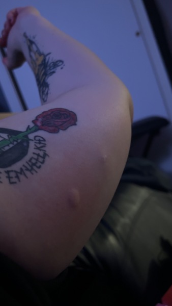Weird lump suddenly appeared on arm by implant