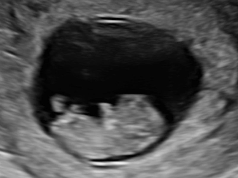 Is this nuchal translucency or amnion? Any sonographers out there..? 🙏
