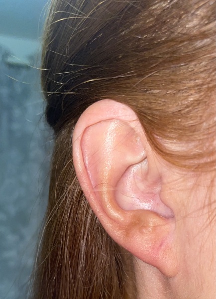 Petrified I have melanoma on my ear lobe- picture included