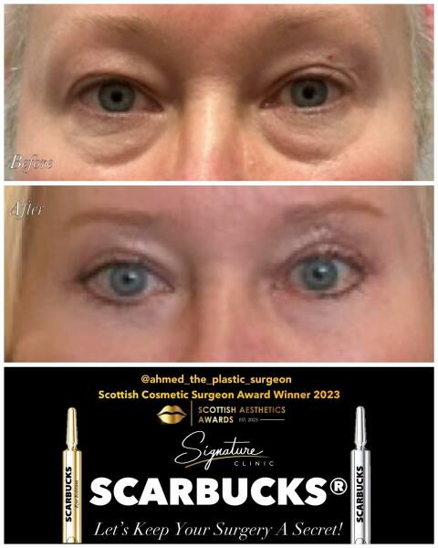 Anyone had upper eyelid surgery?