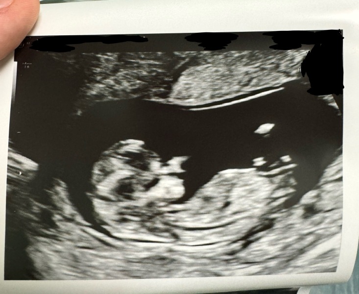 12 weeks scan girl or boy