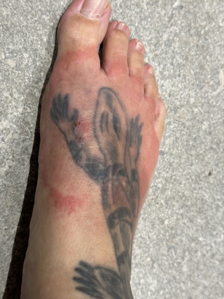 Reaction to an insect bite