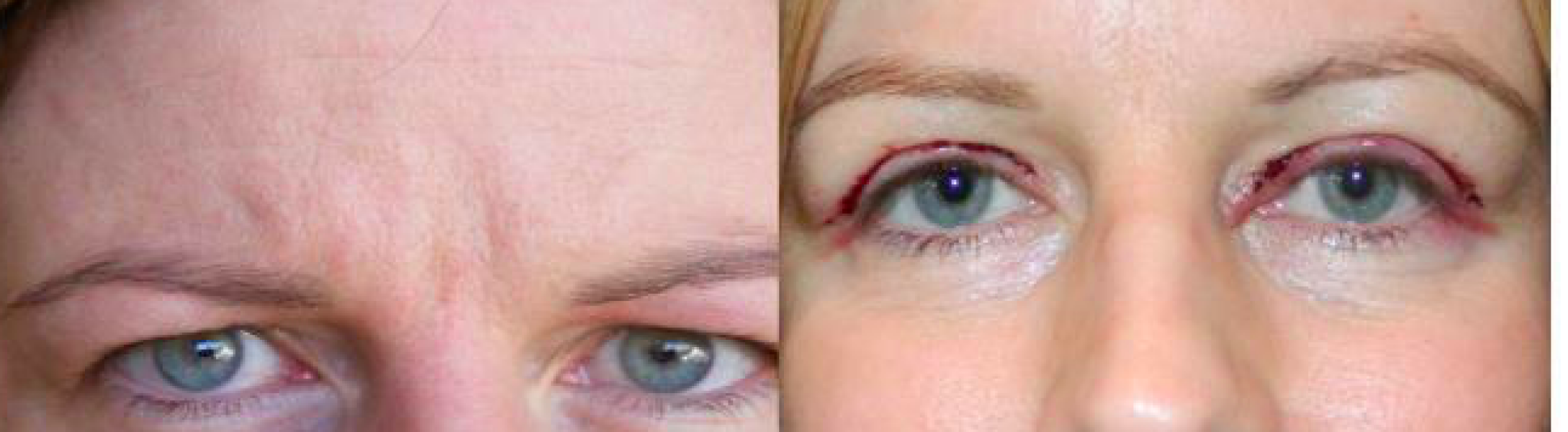 Anyone had upper eyelid surgery?