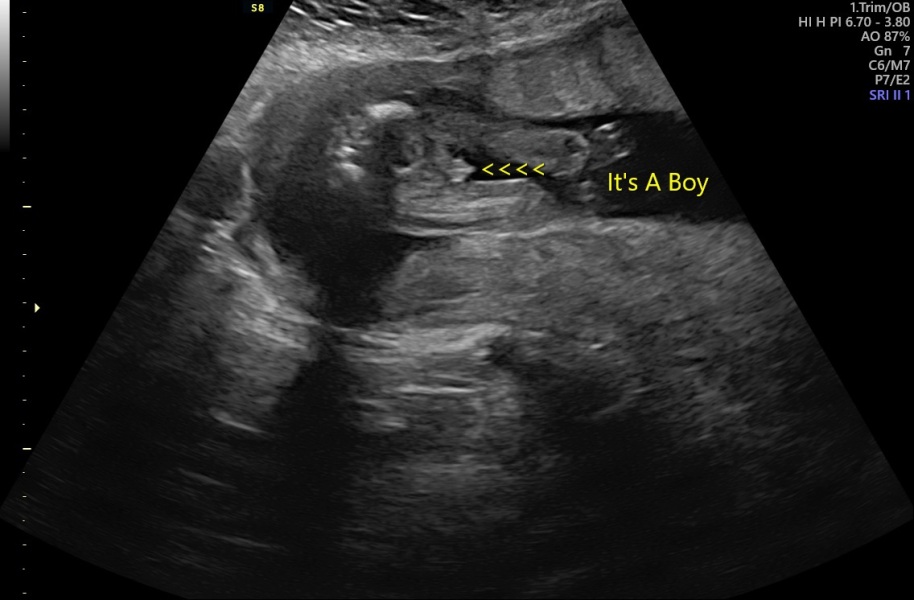 Gender.. boy or girl?