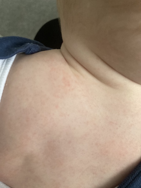 Eczema?