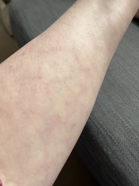 Mottled skin