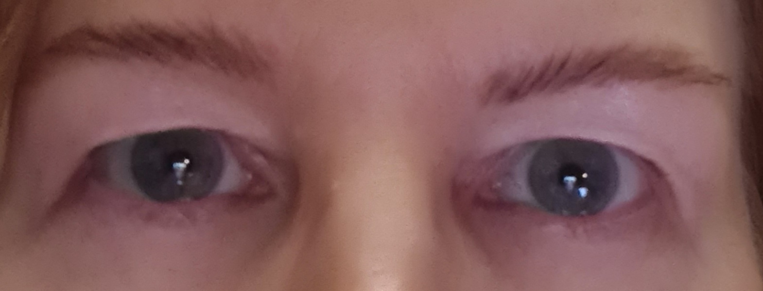Anyone had upper eyelid surgery?