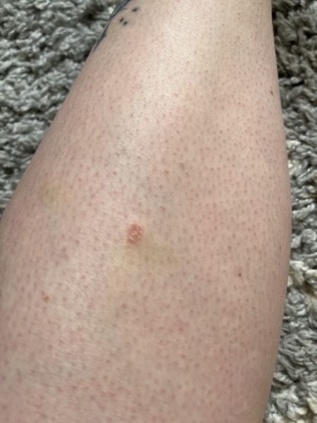 Mark on leg