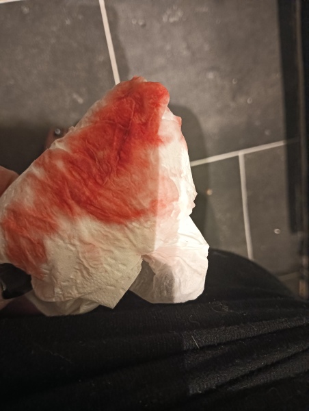 **PICS INCLUDED**. Implantation bleed?