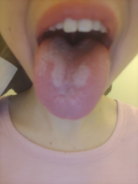 What on earth is wrong with my daughter's tongue?!