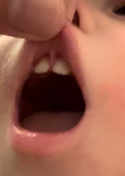 Is this a severe lip tie ? Worried mum
