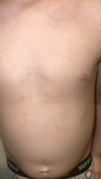 Rash on 5 year old