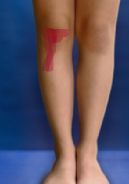 What have I done to my knee?