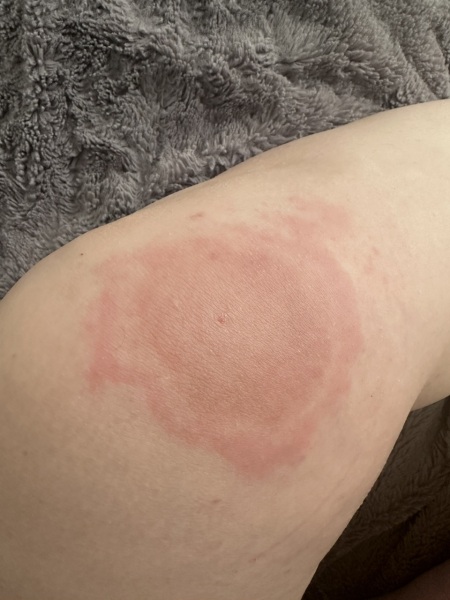 Insect bite