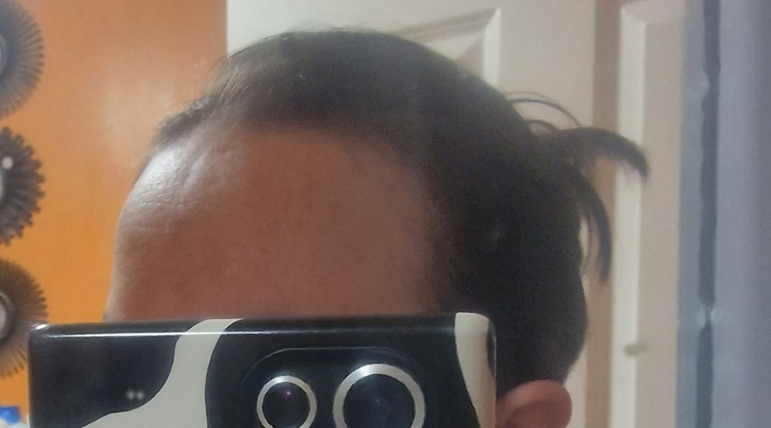 What is this dent in my forhead?!