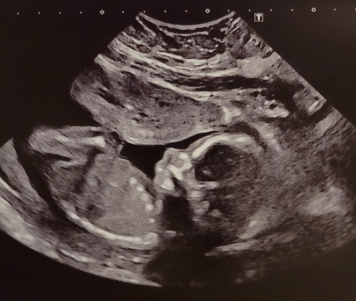 20 week scan pic. Girl or boy