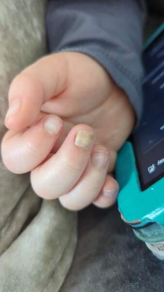 Toddlers fingernail is lifting