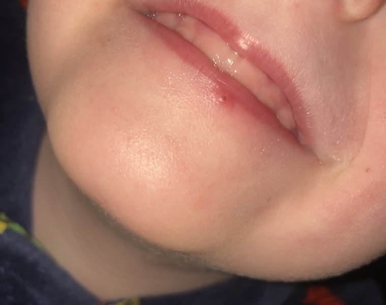 Spot or cold sore?