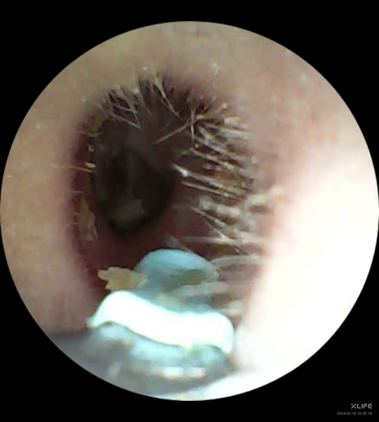 Ear scooper cameras....