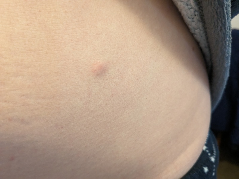 Small raised lump on stomach