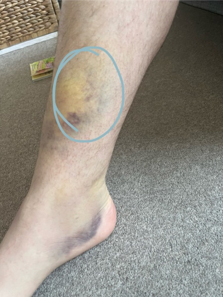 Pics included: does this need medical attention?