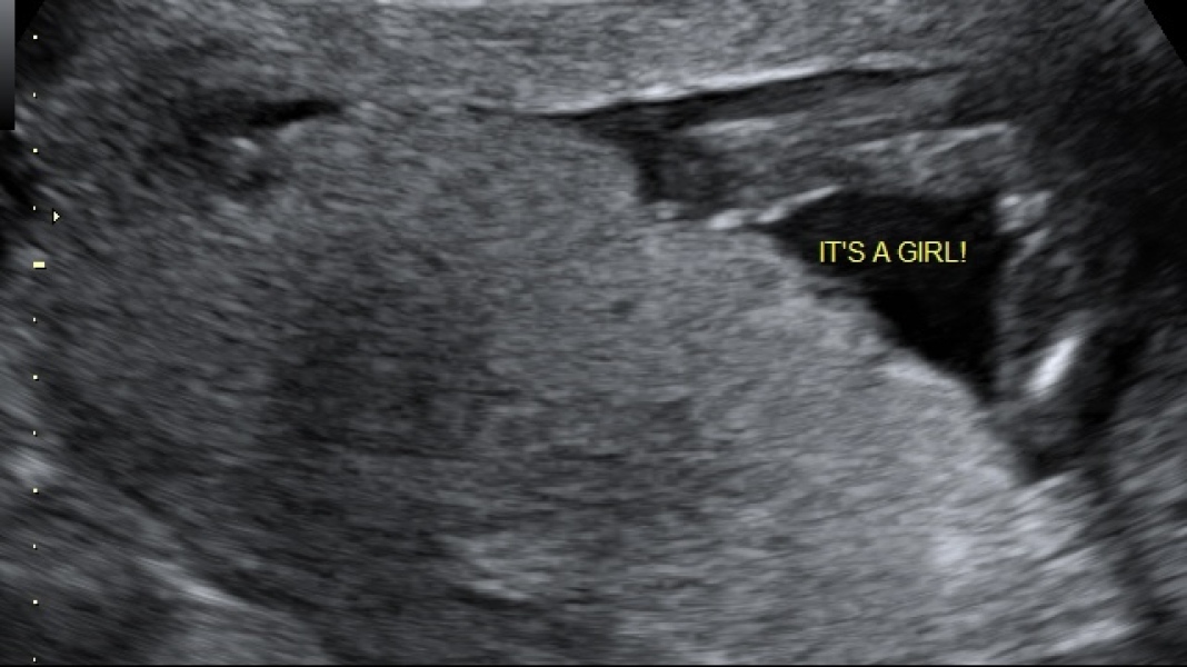 Gender scan