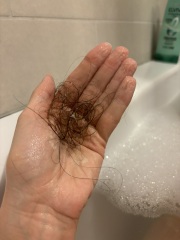 At my wits end with hair loss.