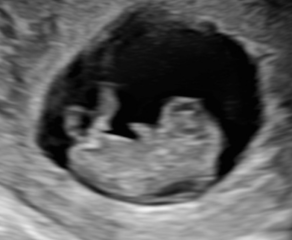 Is this nuchal translucency or amnion? Any sonographers out there..? 🙏