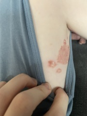 Skin infection HELP