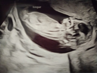 Boy or girl? Nub at 13 weeks