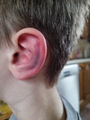 Bruised ear